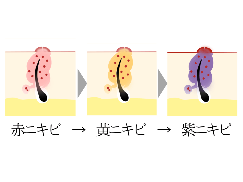 紫 ニキビ跡 安い コンシーラー