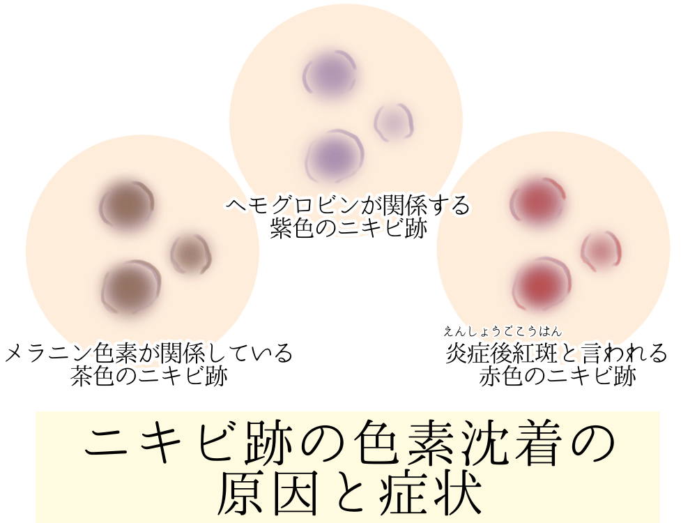 ニキビ跡の色素沈着の原因と症状