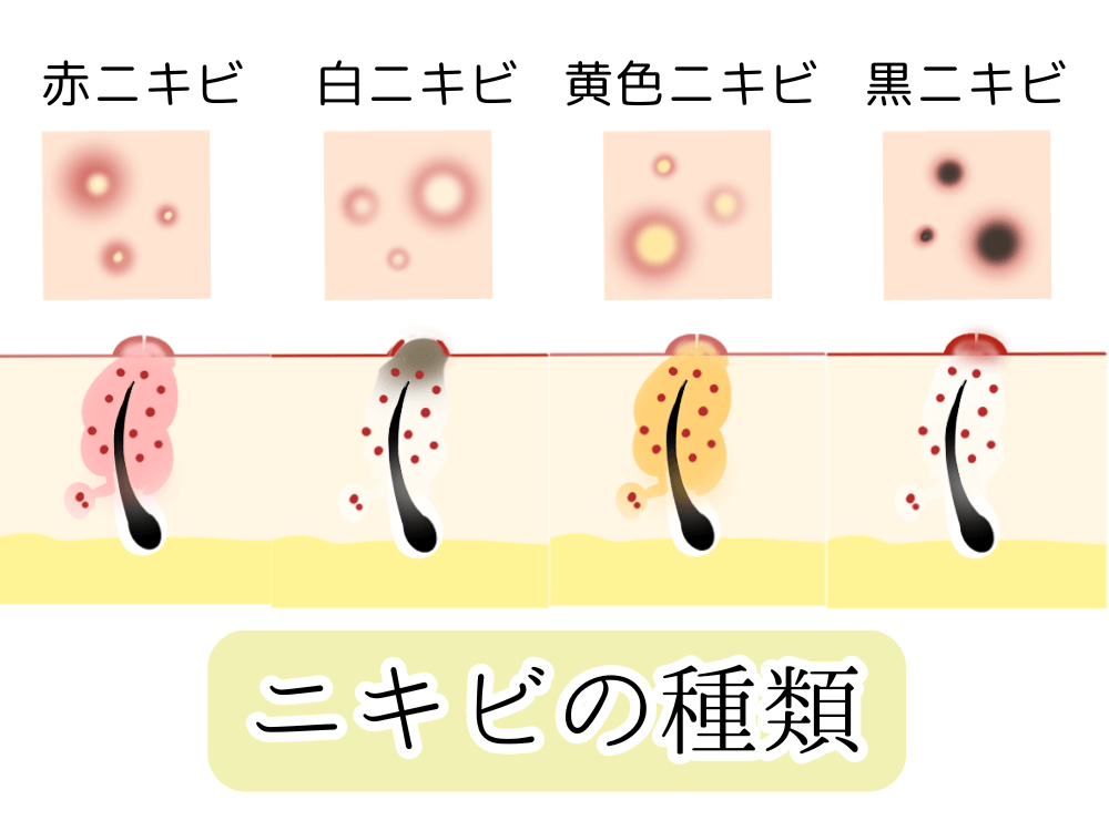 ニキビの種類別のシミ4つ