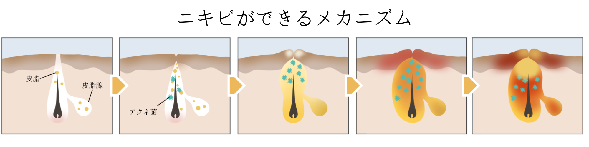 ニキビができるメカニズム