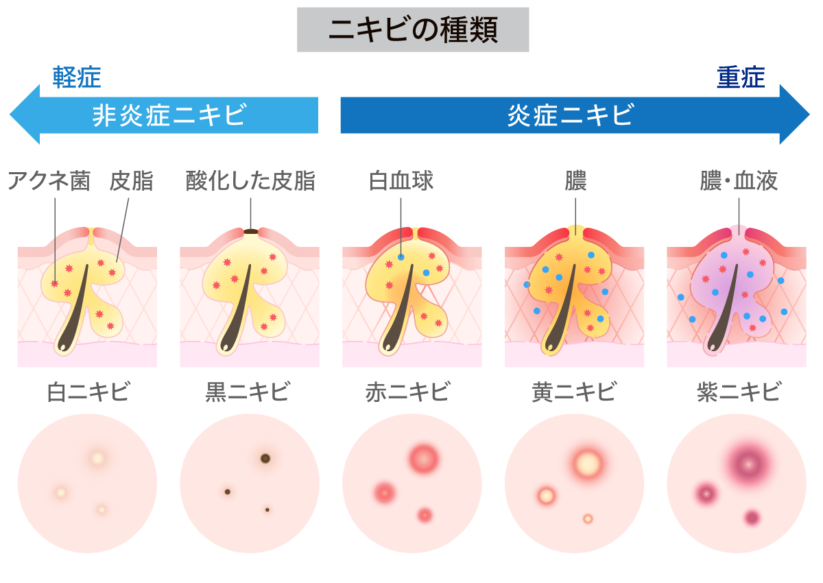 ニキビには種類がある