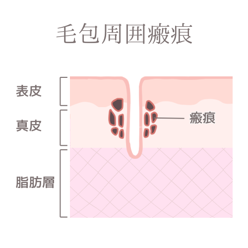 毛包周囲瘢痕