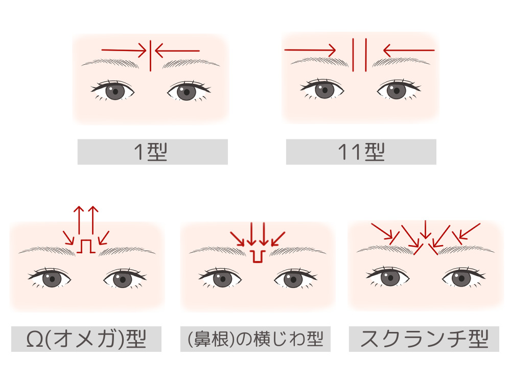 眉間のシワのパターン・種類