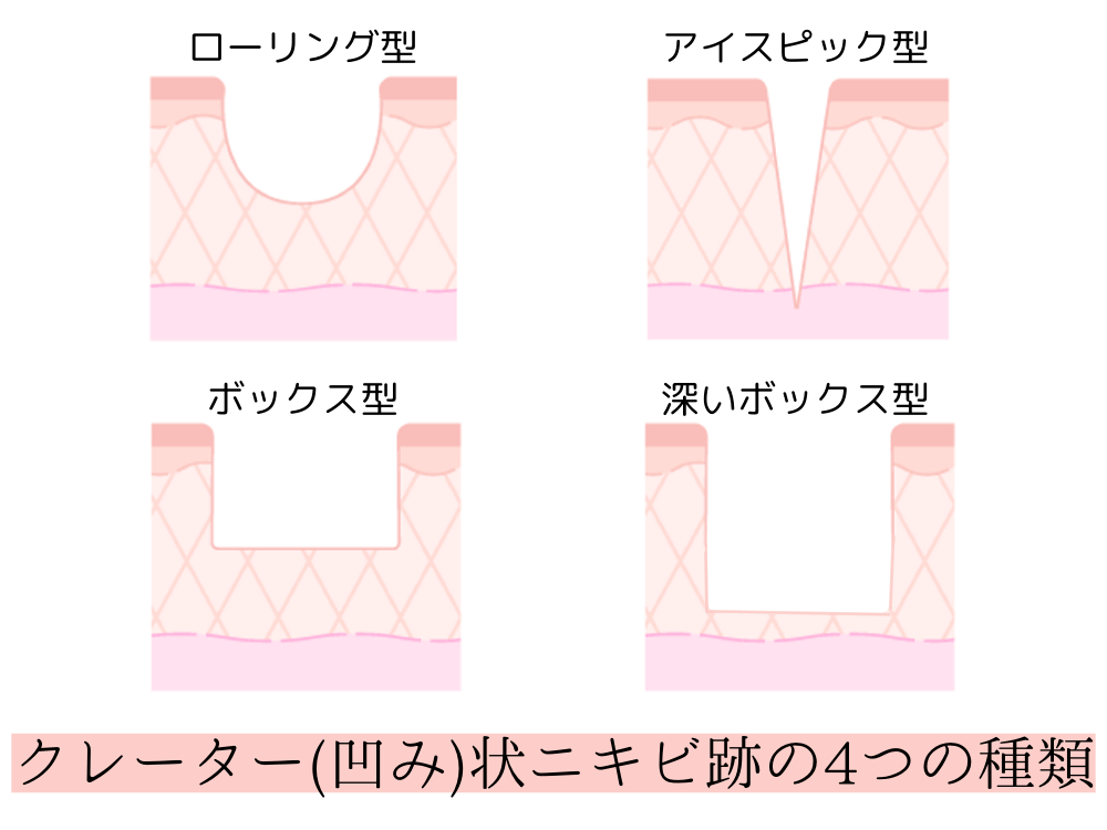 クレーター（凹み）状ニキビ跡の4つの種類