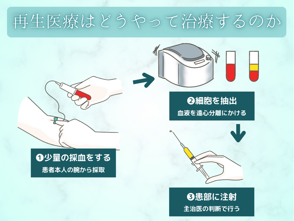 再生医療はどうやって治療するのか