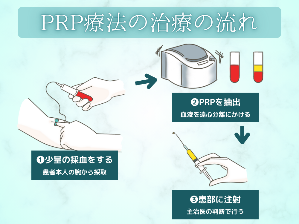 PRP療法の治療の流れ