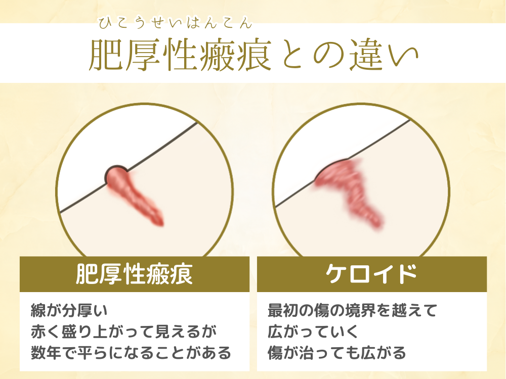 間違われやすい肥厚性瘢痕（ひこうせいはんこん）との違い