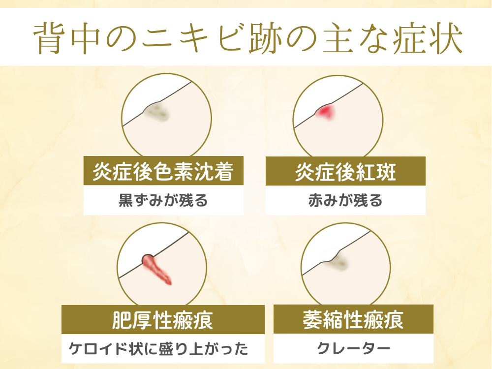 背中のニキビ跡の主な症状