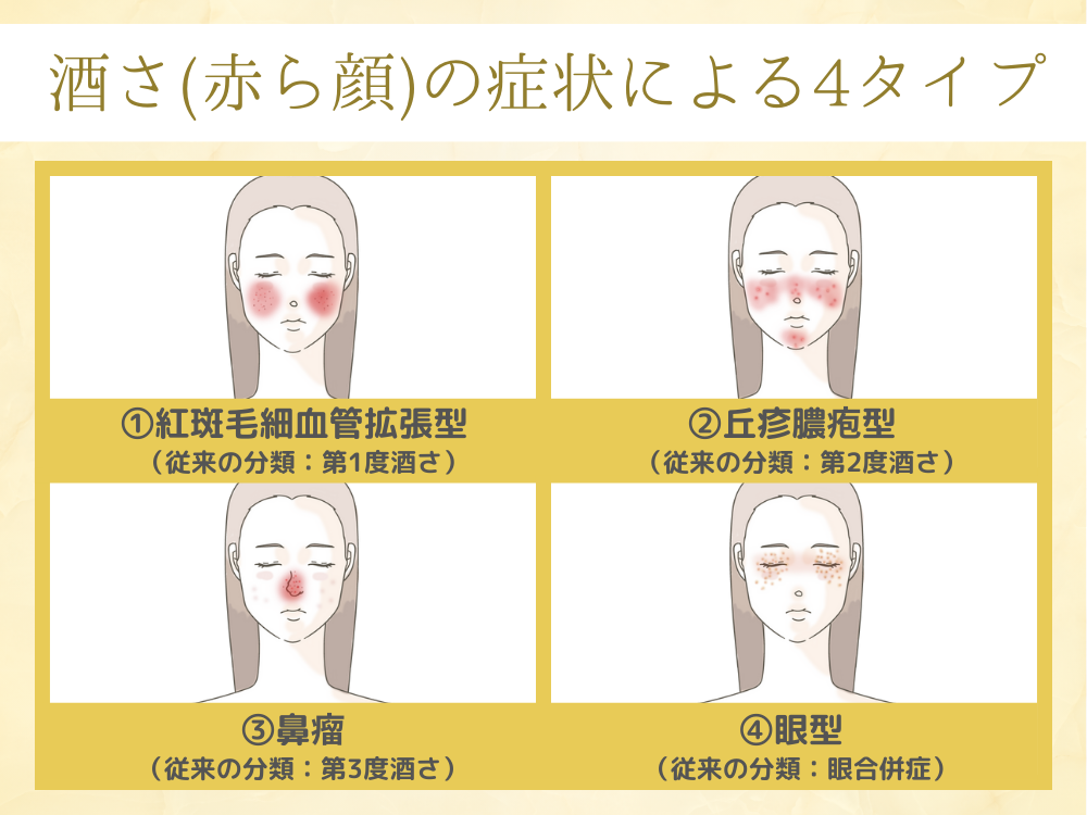 酒さ(赤ら顔)の症状による4つのタイプ