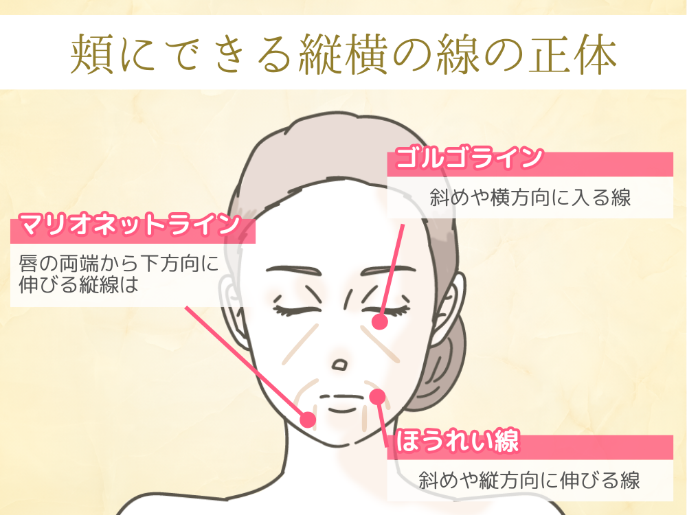 頬にできる縦横の線の正体