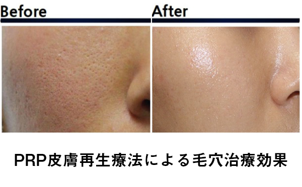 フォーシーズンズ美容皮膚科クリニックPRP皮膚再生療法による毛穴治療効果