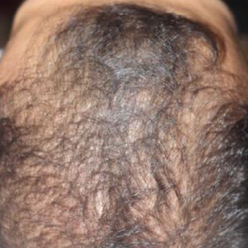 毛髪再生療法、薄毛改善、育毛治療
