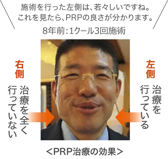 PRP治療の効果
