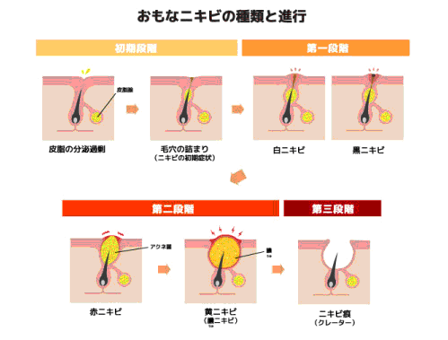 ニキビの進行