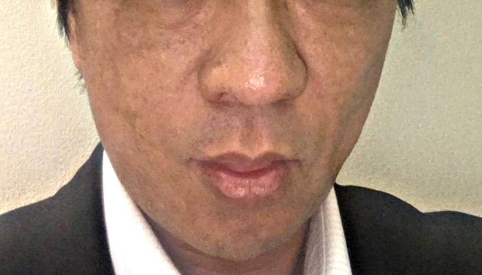 PRP皮膚再生医療after