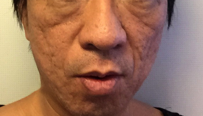 PRP皮膚再生医療before