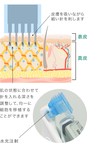 水光注射