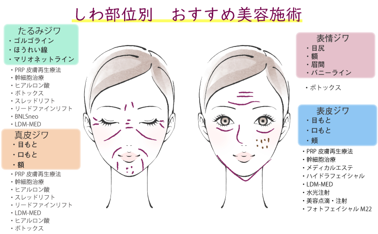 しわ部位別 おすすめ美容施術