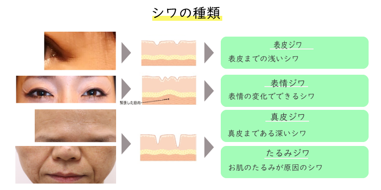 シワの種類は、表皮ジワと表情ジワと真皮ジワとたるみジワ等。