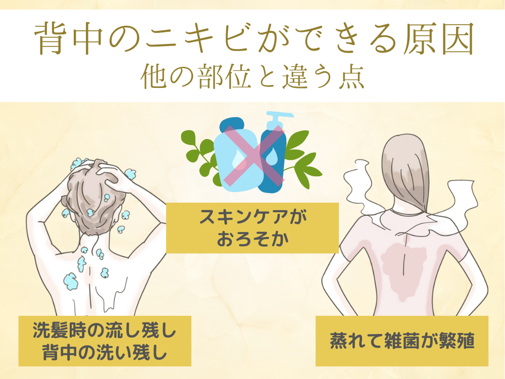 背中のニキビ跡ができる理由は?跡を残さないケア方法や間違えやすい症状も紹介 | フォーシーズンズ美容皮膚科クリニック美容コラム