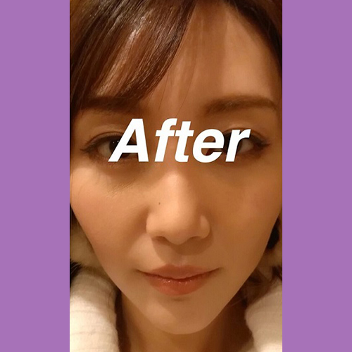 施術後写真