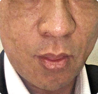 施術後写真