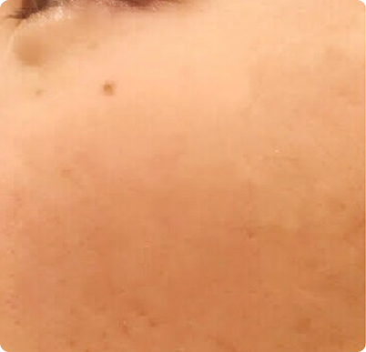 施術後写真