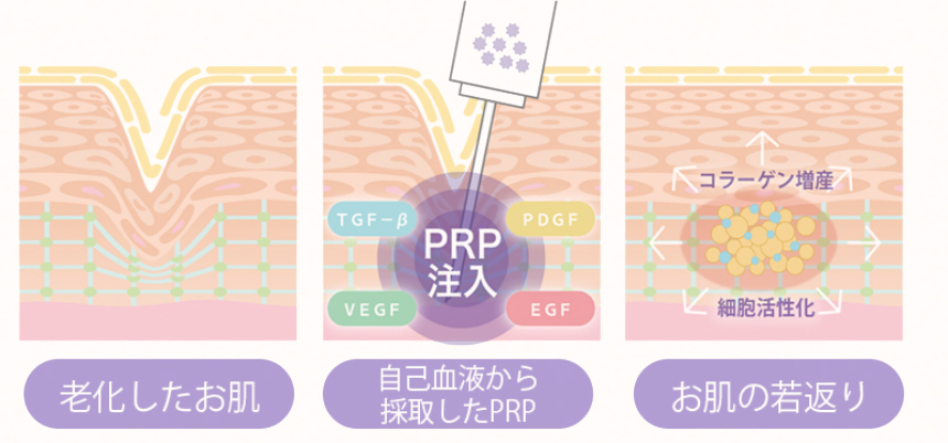 PRP皮膚再生療法のしくみ