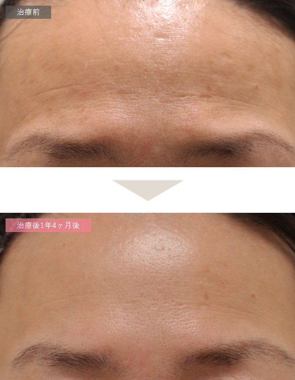 顔 の 皮膚 の 再生