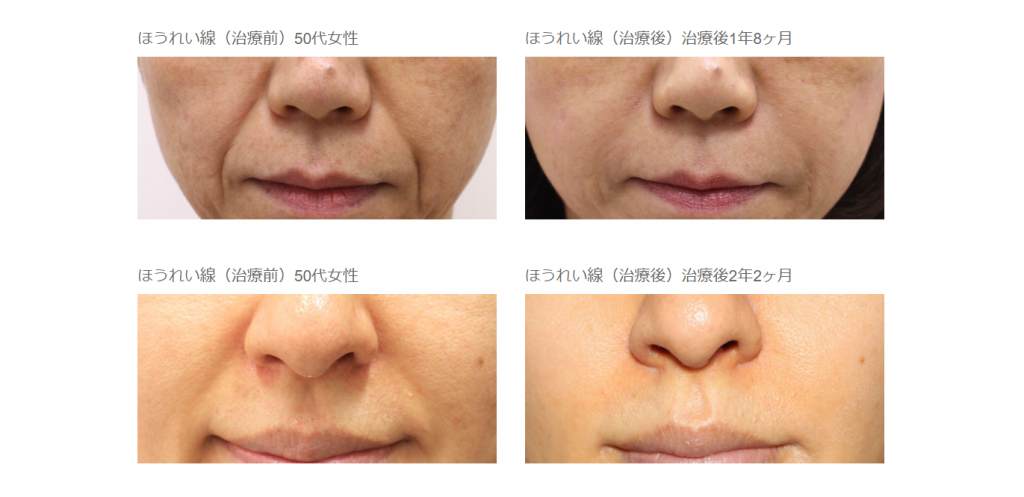 シワ治療 フォーシーズンズ美容皮膚科クリニック 美容外科