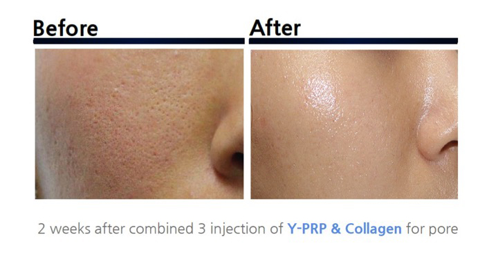 PRP皮膚再生療法　ビフォーアフター