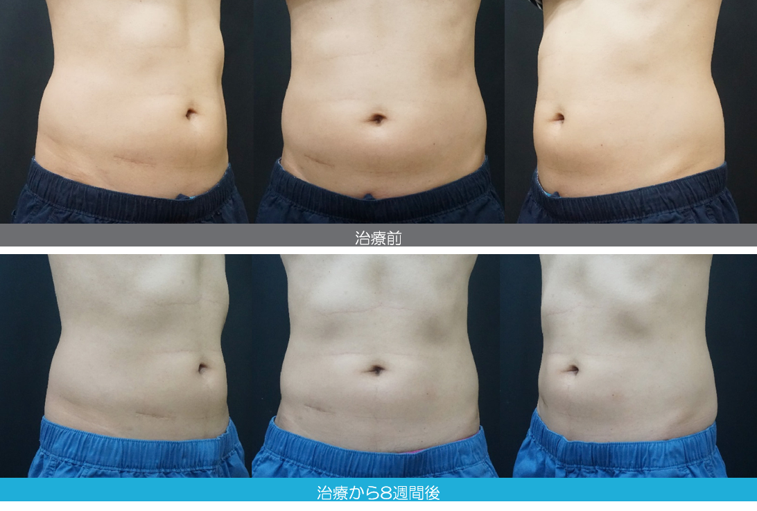 腹部 クラツー