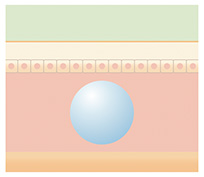 ヒアルロン酸治療工程 loading=