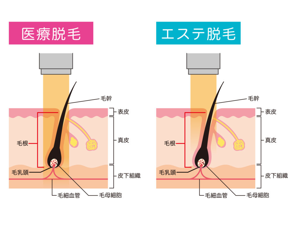 医療脱毛とエステ脱毛の違い