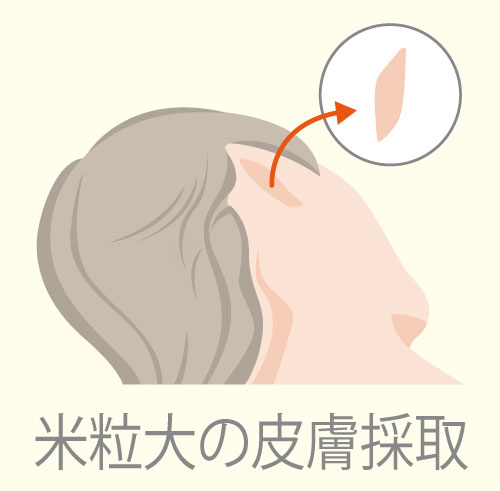 皮膚採取のイメージ
