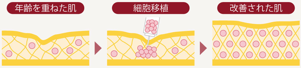 幹細胞治療イメージ