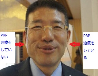PRP治療症例