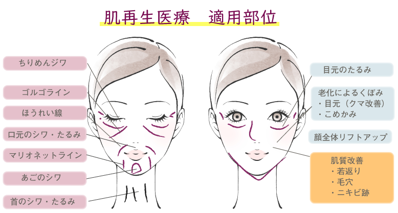 肌再生医療の適用部位