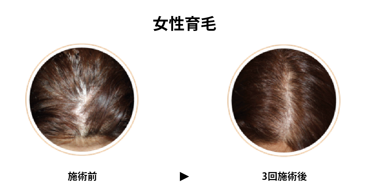 ACRS女性育毛PC