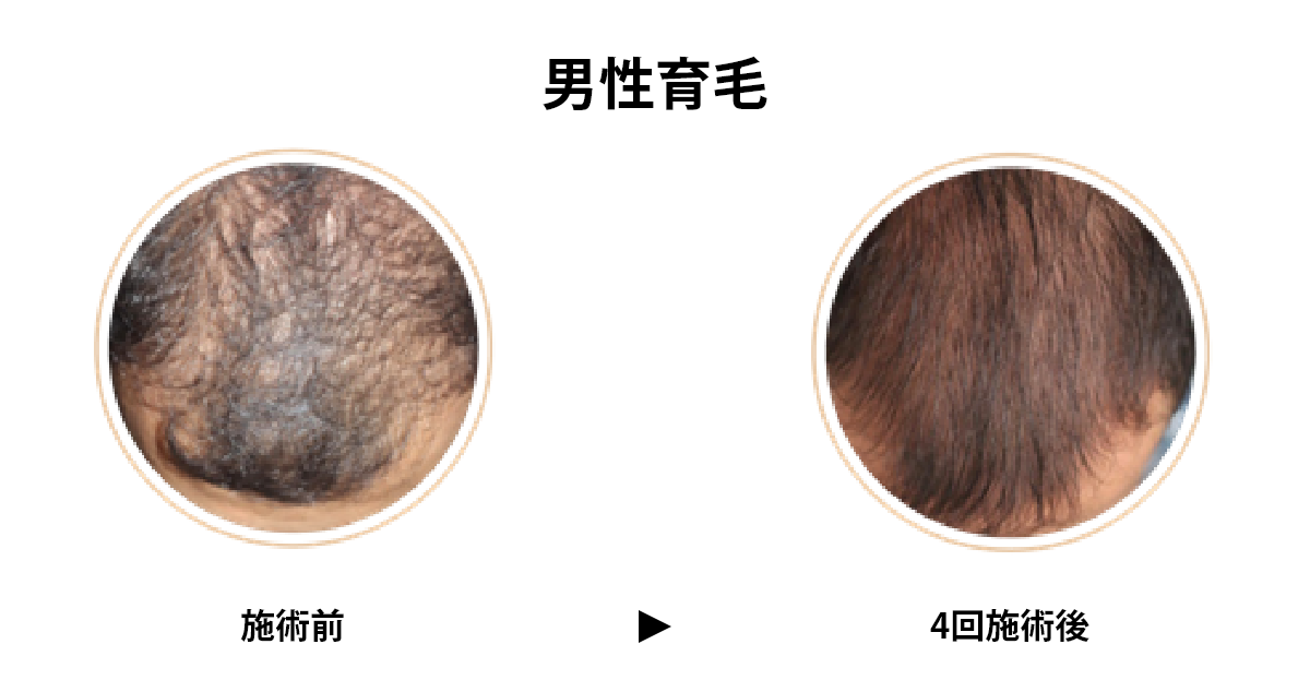ACRS男性育毛PC