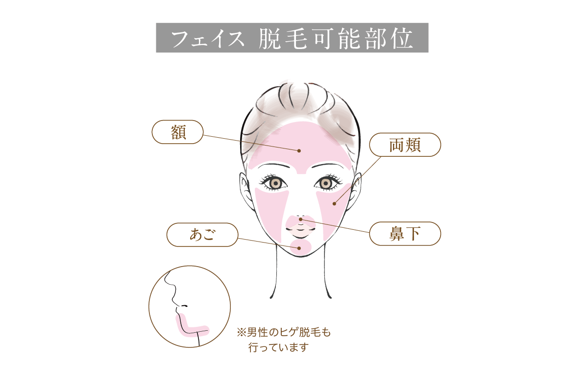 脱毛部位、顔説明