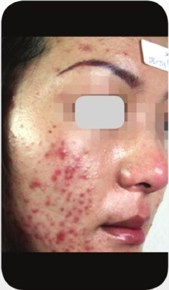 フォトフェイシャルM22施術前写真4