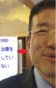 PRP施術前