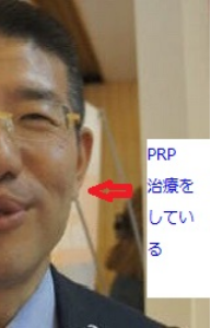 PRP施術後