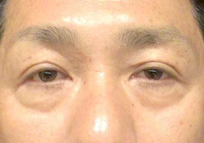 目元PRP クマ施術前