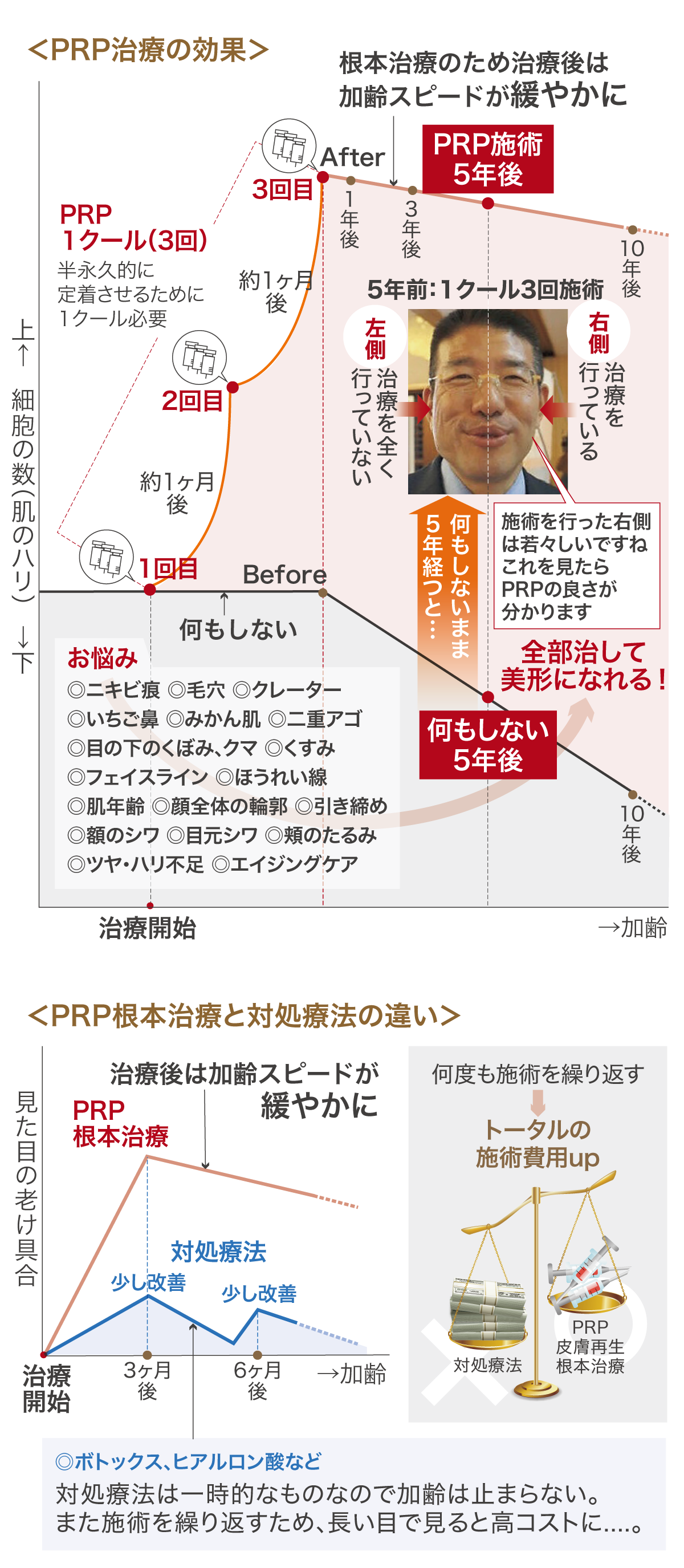 PRPの効果図