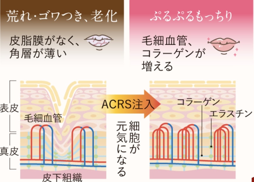 神戸の美容外科クリニックでくちびるの美容整形（ACRS注入）