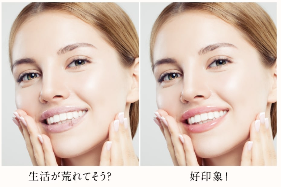 神戸の美容外科クリニックで口元の美容整形をした女性