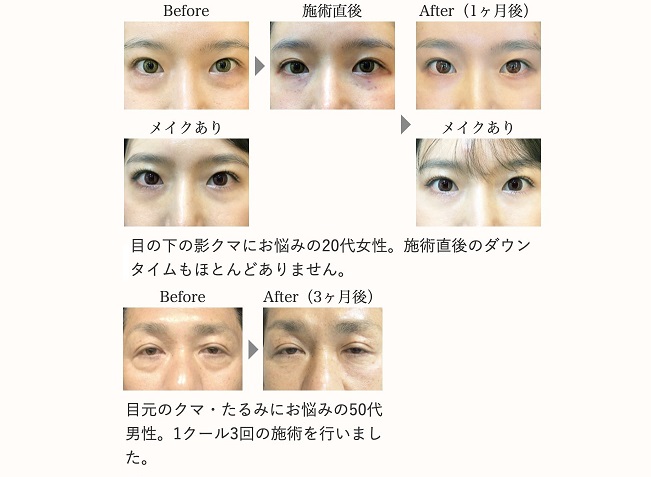 神戸のフォーシーズンズ美容皮膚科／美容外科が解説！眼瞼下垂・代償期とは？
