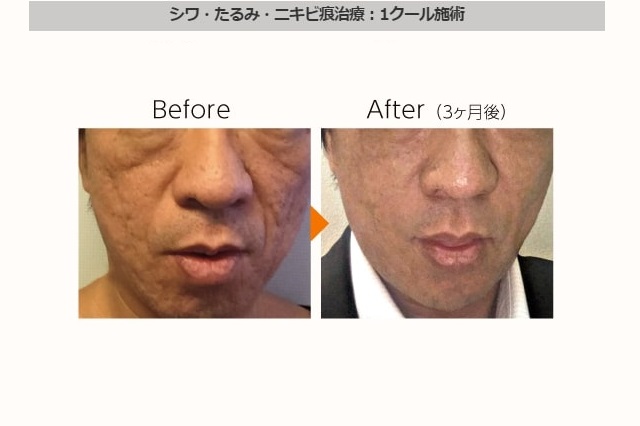 神戸の美容皮膚科クリニックが解説！ニキビ痕クレーターの種類と症状について